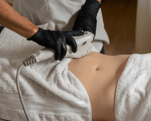 Abdomen Tightening by HIFU