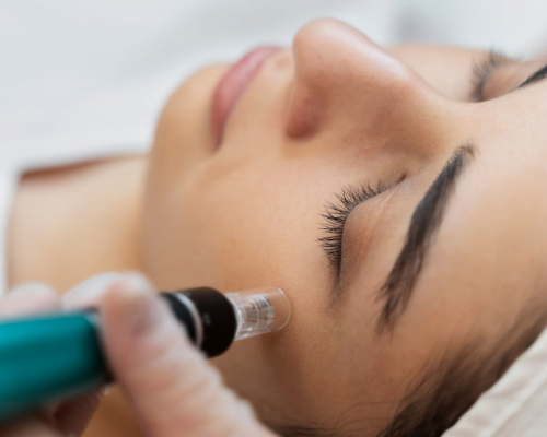 Periorbital Rejuvenation by Nano needling