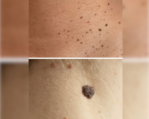 Removal of Skin Tags & Warts by Pixel CO2 LASER of ALMA