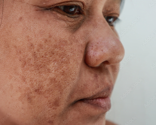 Treatment of Melasma