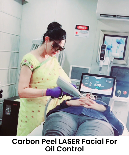 Carbon Peel LASER Facial For Oil control