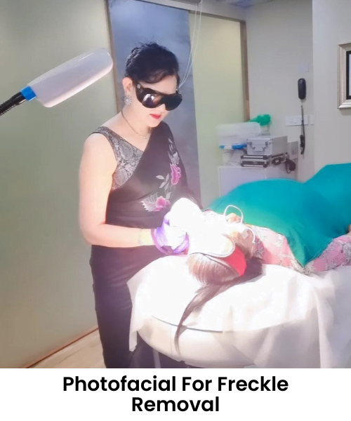 Photofacial For Freckle Removal