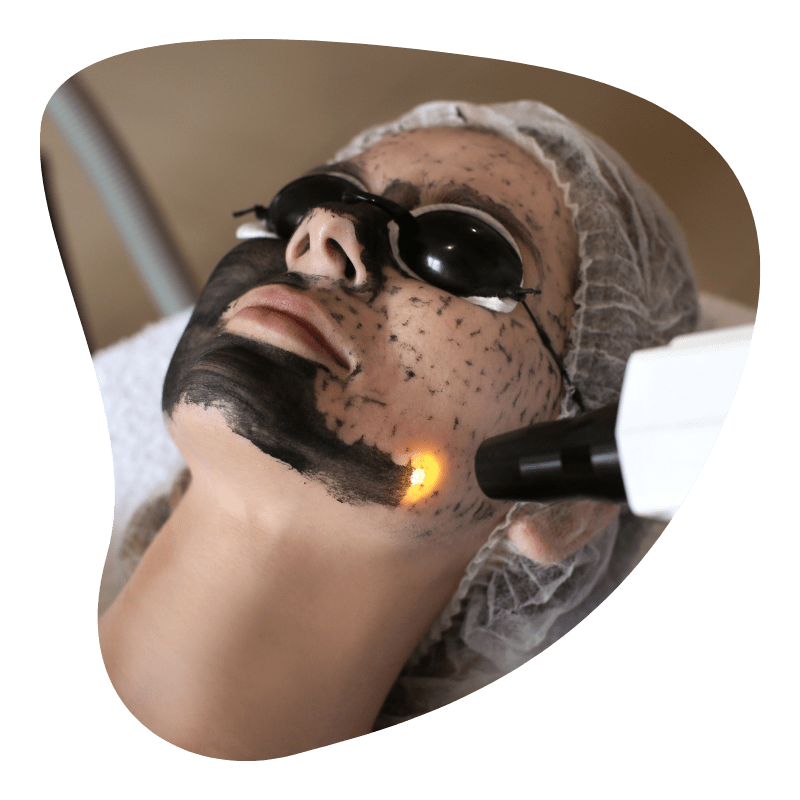 Carbon laser facial treatment in Udaipur, Carbon laser facial specialist in Udaipur