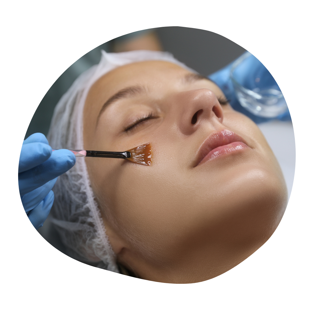 Chemical peels treatment in Udaipur